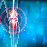 Methotrexate beneficial for reducing pain, stiffness in knee osteoarthritis