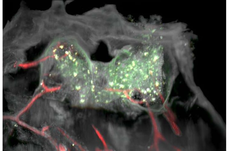 Surprising finding in glioblastomas: