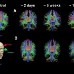 Advanced MRI scans help identify one in three concussion patients with 'hidden disease'