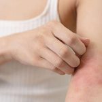 Dietary vitamin E may be protective against atopic dermatitis