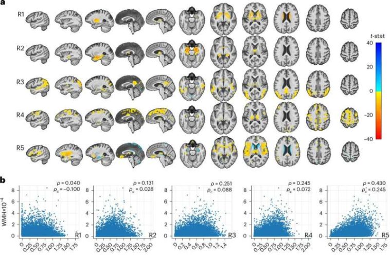 Large-scale brain imaging study reveals five patterns of age-related degeneration