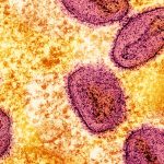 Mpox New Strain Reported in Sweden, Marks the First Case Outside of Africa