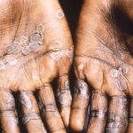 Mpox lesions often appear on the palms of hands. (file)