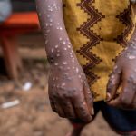 The urgent fight against mpox in Congo's refugee camps