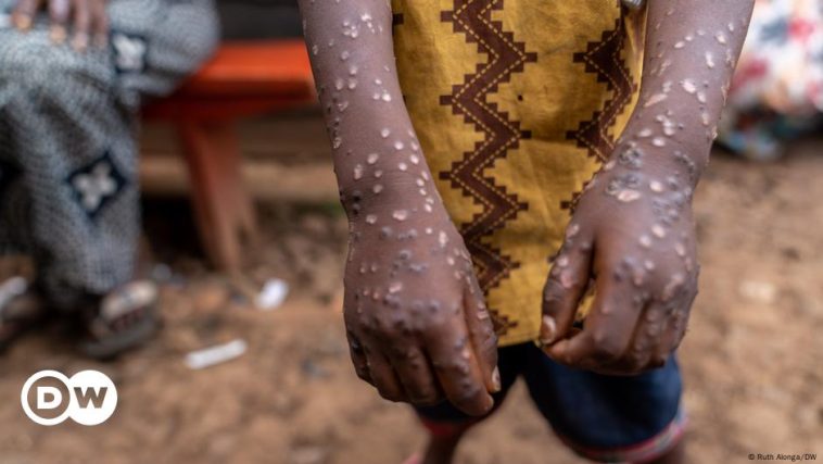 The urgent fight against mpox in Congo's refugee camps