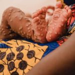 Mpox in the DRC: children are at high risk—health expert explains why