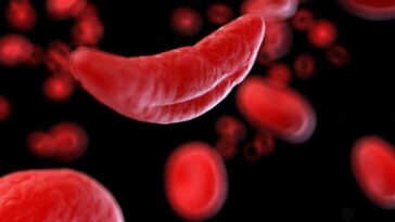 Sickle cell disease