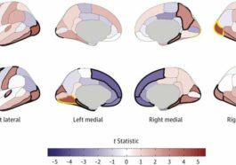 Does substance use change brain's structure, or does brain structure predispose some to substance use?